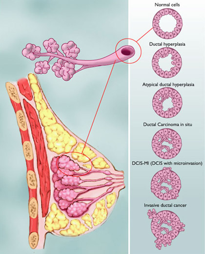 ductal-breast-cancer-in-situ-dcis-risk-factors