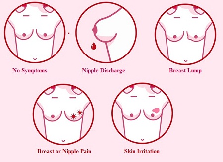 Ductal Breast Cancer in situ Symptoms 