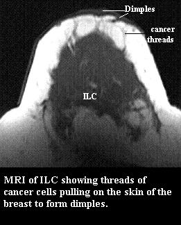 MRI showing Invasive Lobular Cancer