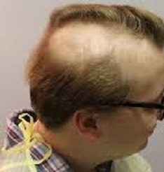 Hair Loss after Radiotherapy