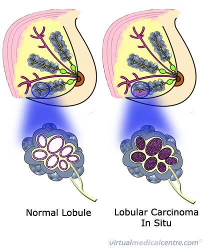 Lobular Breast  Cancer in Situ