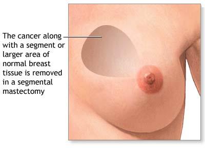 Lumpectomy of the Breast