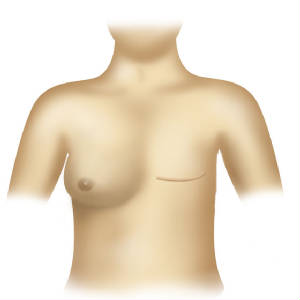 Mastectomy of the Breast