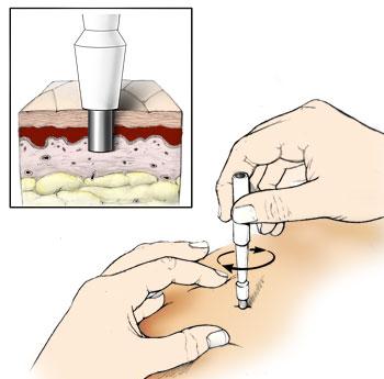 Punch Biopsy