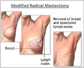 Mastectomy of the Breast