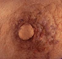 Paget's Disease of the Nipple/Breast
